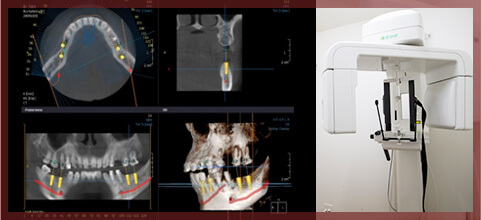 歯科用CTの導入