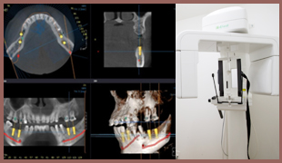 歯科用CTの導入